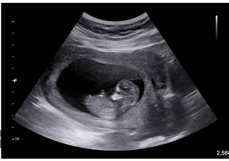 When Should You Get Your First Pregnancy Ultrasound?