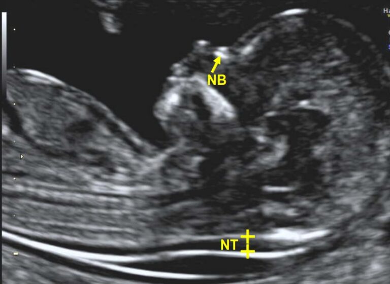 NT Scan at 11–13 Weeks: Why It Is Important for Your Baby